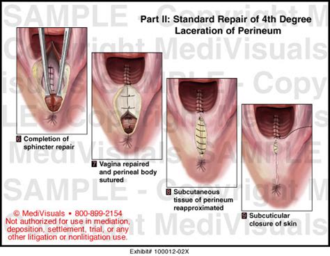 Medivisuals Standard Repair Of 4th Degree Laceration Of