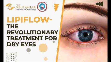Lipiflow The Revolutionary Treatment For Dry Eyes At The Sight Avenue