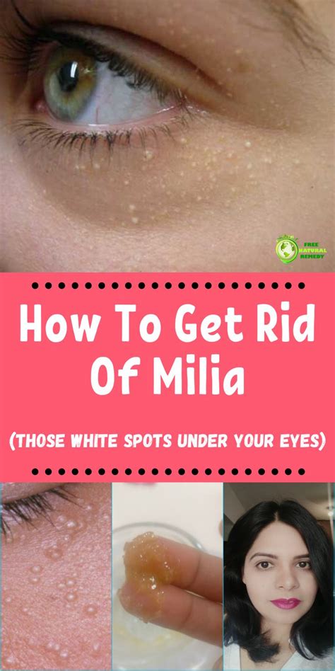 Wet the skin under the eyes and apply a percentage of exfoliator to the area. How To Get Rid Of Milia (Those White Spots Under Your Eyes ...