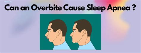 Can An Overbite Cause Sleep Apnea Snooze Ez