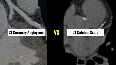 Ct Coronary Angiogram Vs Ct Calcium Score Differences