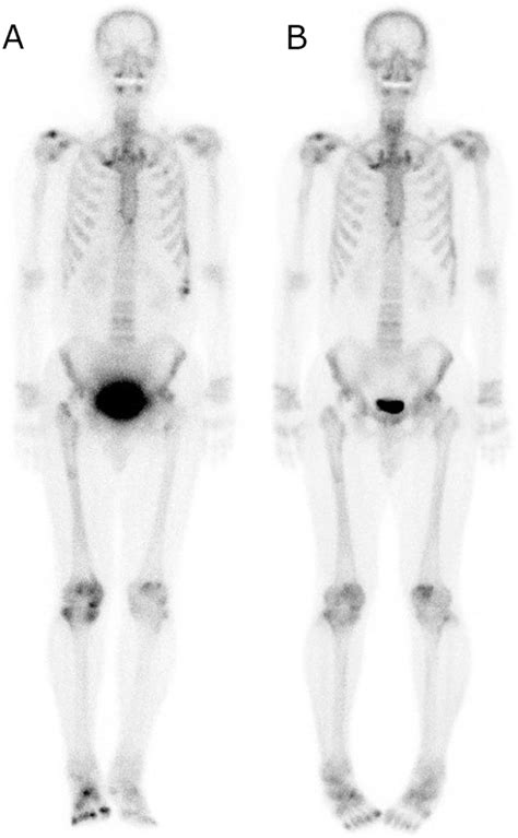 99m Tc Bone Scintigraphy In Case 2 A Was Performed On Day 7