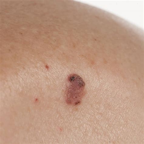 How Bad Is Squamous Cell Carcinoma