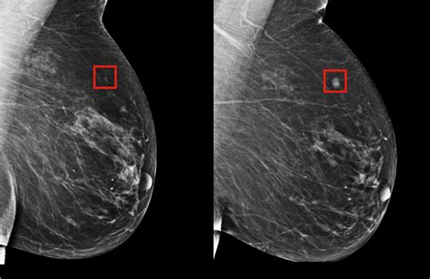 Using Ai To Predict Breast Cancer Five Years Out