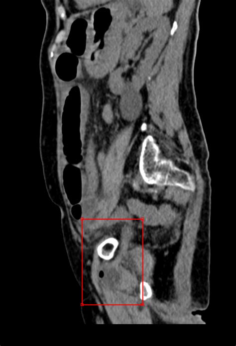 Small Bowel Obstruction Secondary To Obturator Hernia Eurorad