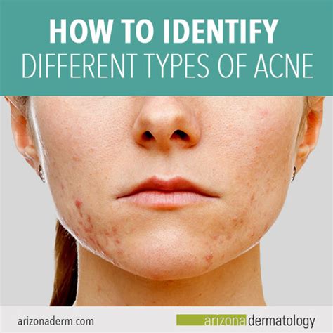 How To Identify Different Types Of Acne Arizona Dermatology