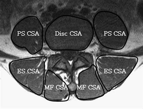 Mri Of Paraspinal Muscles In Lumbar Degenerative Kyphosis Patients And