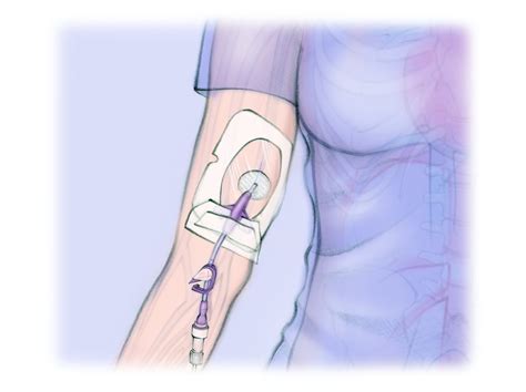 Peripherally Inserted Central Catheter Picc — The Interventional