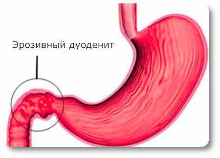 Проксимальный дуоденит диета Эрозивный дуоденит: что это такое, симптомы и лечение, диета при Эрозивный дуоденит: что это такое, симптомы и лечение, диета при Проксимальный дуоденит диета
