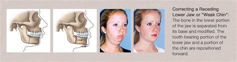 The Procedure Orthognathic Surgery