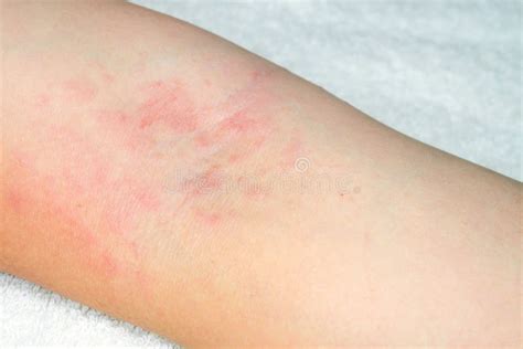 Allergy To Red Rash On The Arms Stock Photo Image Of Allergy