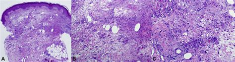 Palisaded Neutrophilic Granulomatous Dermatitis Spectrum Of Histologic