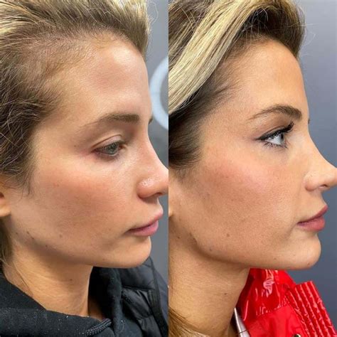 Photos Naomie Olindo Gets Fillers And Debuts New Jawline Southern