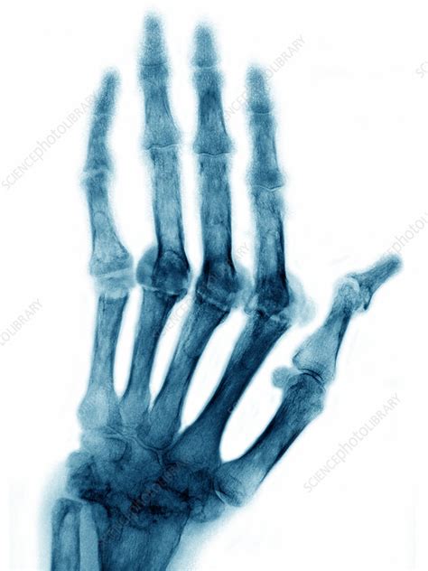 Rheumatoid Arthritis X Ray Stock Image C0272198 Science Photo