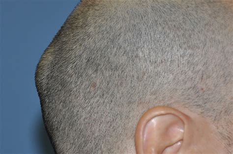 Lump On Back Of Head Learn Most Common Reason Of Bump On Back Of Head