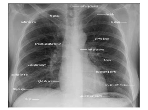 It is almost always the first imaging study ordered to evaluate for pathologies of the thorax, although further diagnostic imaging, laboratory tests. Chest x rays | Radiology student, Medical education ...