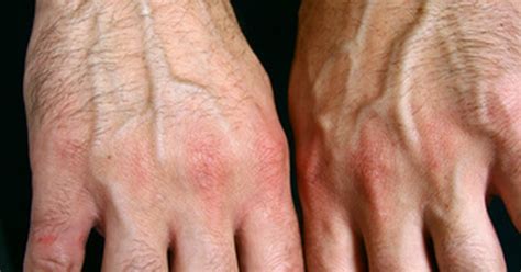 What Causes Arthritis Flare Ups Livestrong