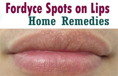 How Do You Get Fordyce Spots On Lips How To Treat Fordyce Spots On