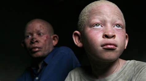 Ending Albino Persecution In Africa Africa Renewal