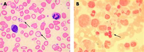 Blood Film And Bone Marrow Smear From The Index Case A Wright Giemsa