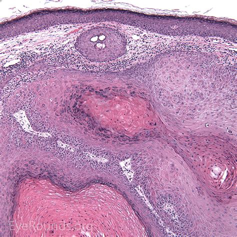 Malignant Lesions of the External Periocular Tissues Tutorial