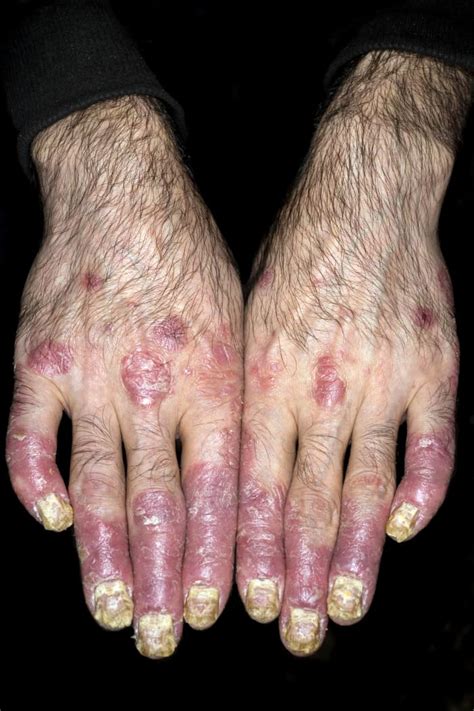 What You Need To Know About Psoriasis Vs Eczema Hubpages