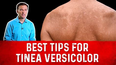 Best Tips For Tinea Versicolor Treatment Skin Fungus Drberg Youtube