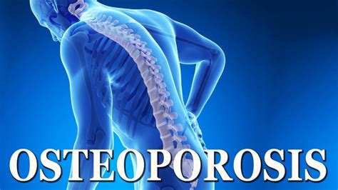 What Is Osteoporosis Getdoc Says