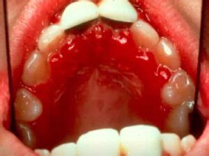 Understanding Oral Herpes Primary Acute Herpetic Gingivostomatitis