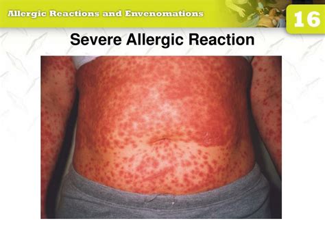 Ppt 16 Allergic Reactions And Envenomations Powerpoint Presentation