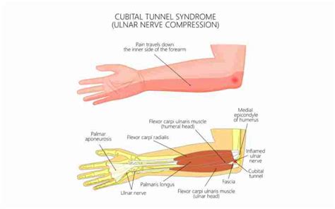 Injections For Cubital Tunnel Syndrome Steroid Injections For Elbow