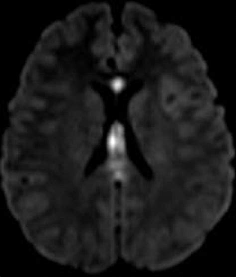 The Fornix In Health And Disease An Imaging Review Radiographics