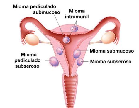 Miomas uterinos Nueva técnica de ablación por radiofrecuencia
