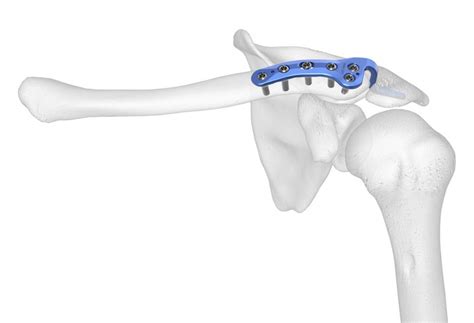 El Clavicle Plating System Hook Plate On Bone Acumed