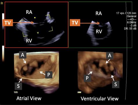 The Role Of Intracardiac Echocardiography In Percutaneous Tricuspid
