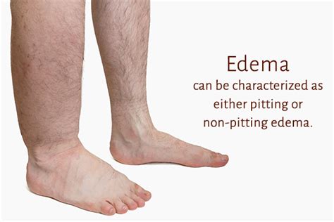 What Is Edema And How To Treat It Emedihealth