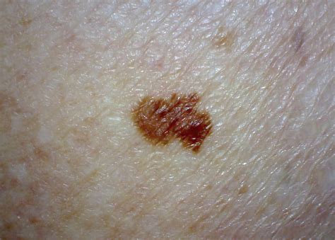 Early Stage Melanoma Cancer Pictures Symptoms And Pictures