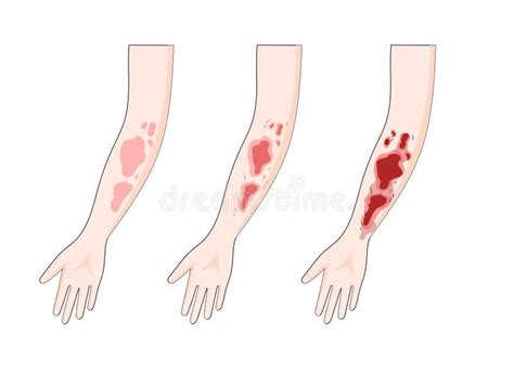 Skin Burn Degree Stock Illustrations 130 Skin Burn Degree Stock