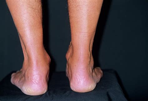Swollen Achilles Tendon Photograph By Dr P Marazzi Science Photo Library