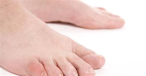 How To Care For A Swollen Toe Livestrongcom