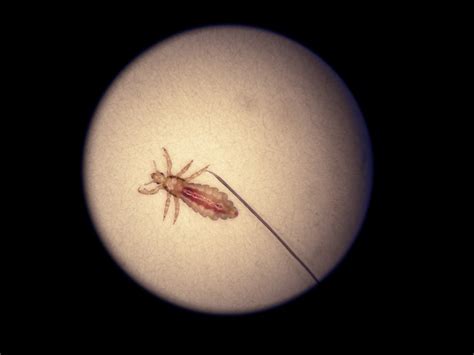 Cases of Super Lice on the Rise Nationwide | Fresh Heads ...