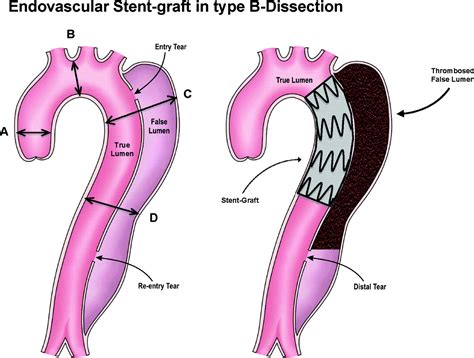 Randomized Comparison Of Strategies For Type B Aortic Dissection