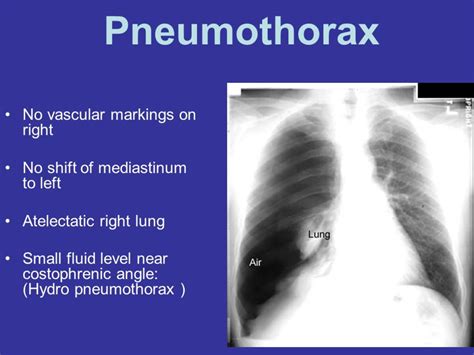 Pneumothorax By Dr Radhika A Md Lybrate