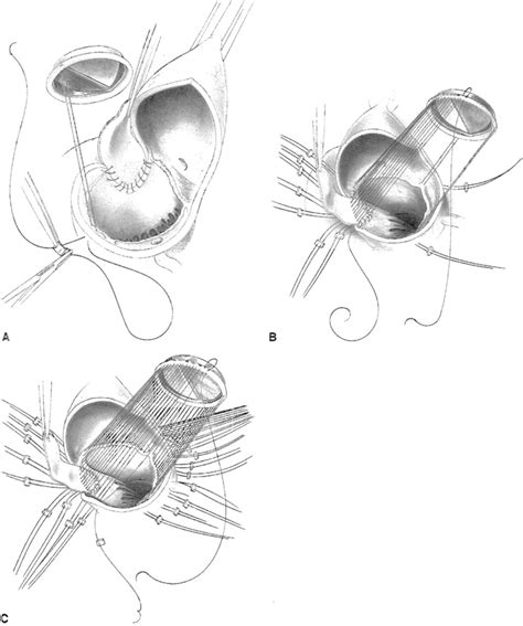References In Posterior Aortic Annular Enlargement For Mechanical