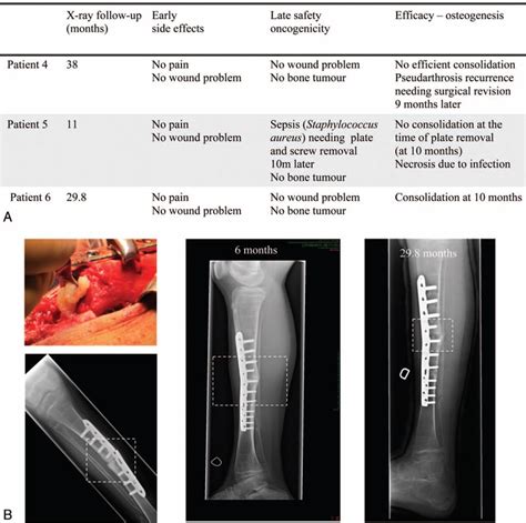 Bone Nonunion In A Case Of Congenital Pseudarthrosis A No Acute