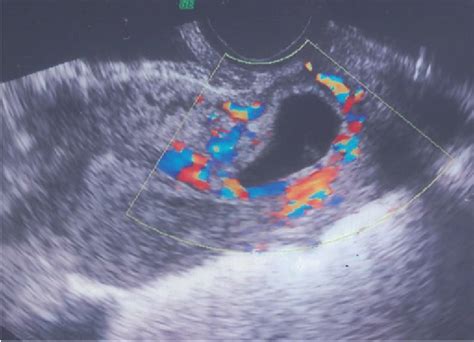 Figure 1 From A Minimally Invasive Hemostatic Strategy For Cesarean Scar Pregnancy And Cervical