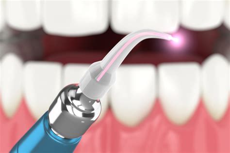 Laser Dentistry Prosper Tx Minty Fresh Dental And Orthodontics