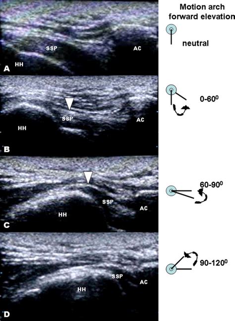 Sonographic Findings With Shoulder Impingement Dynamic Musculoskeletal