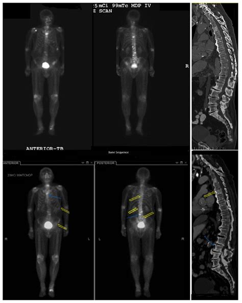 Comparison Of Whole Body Bone Scan And Spine Ct Images Before And After