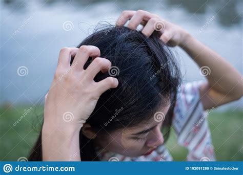 Women Head With Dandruff Caused By The Problem Of Dirty Or Caused By